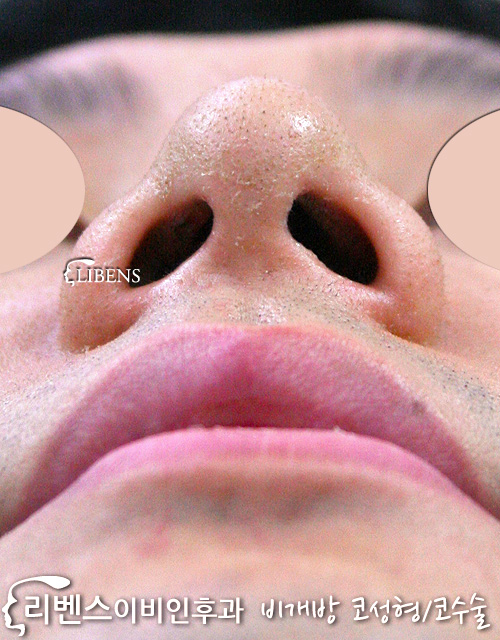 남자 매부리코 메부리코 수술 성형 교정 코끝 연골묶기 비중격 콧대 실리콘 성형 s76